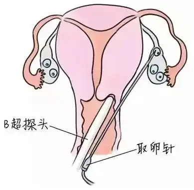 试管婴儿中了解这6个问题让你取卵无忧