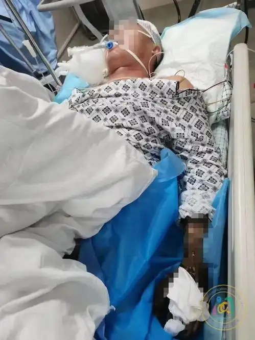 命悬一线福建一男子被眼镜王蛇咬伤,抢救3天仍深度昏迷