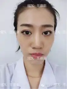 自体脂肪丰面秒变萌萌少女脸,真人故事自述