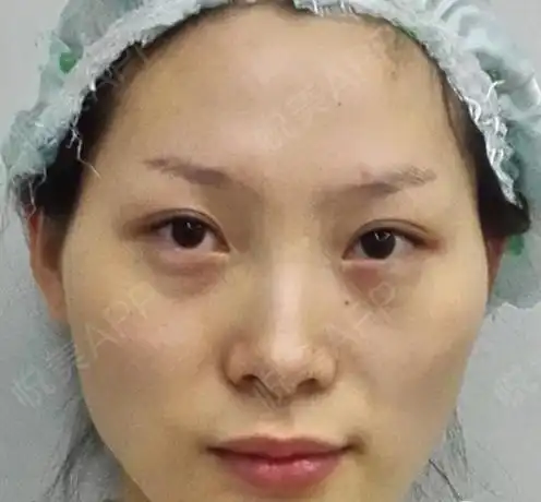 面部凹陷显得老气,没有苹果肌也显得少了许多少女感,...全面部多部位填充悦美整形