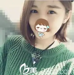 十八岁少女找上海伊莱美李耐国做的全切双眼皮,彻底告别双眼皮贴
