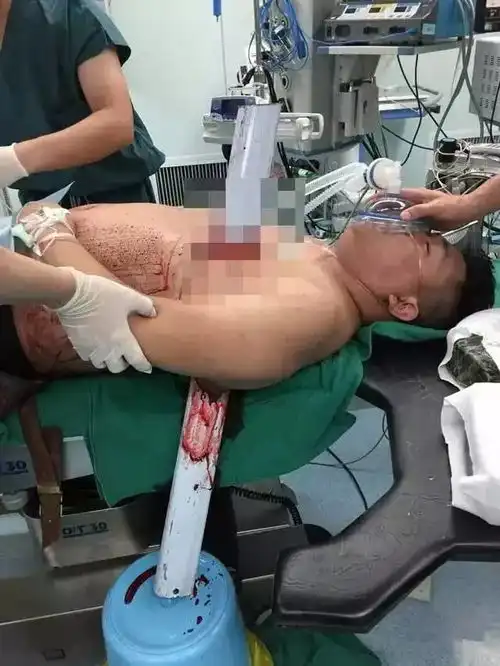 恐怖栏杆刺穿汽车前挡风玻璃直戳驾驶位,南宁女司机伤重身亡