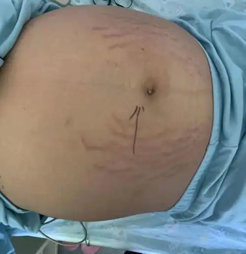 13岁女生肚子隆起爬满妊娠纹,照完ct妈妈当场吓懵