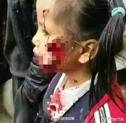女孩被竹叶青咬伤危急情况下如何救护