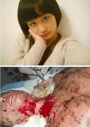 毁容少女家人否认其早恋出院因对方拖欠医药费